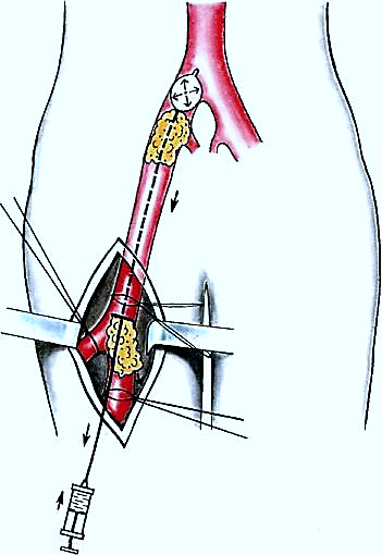 Артерия тромб удаление