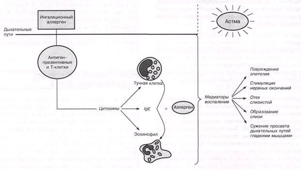 Схема патогенеза бронхиальной астмы