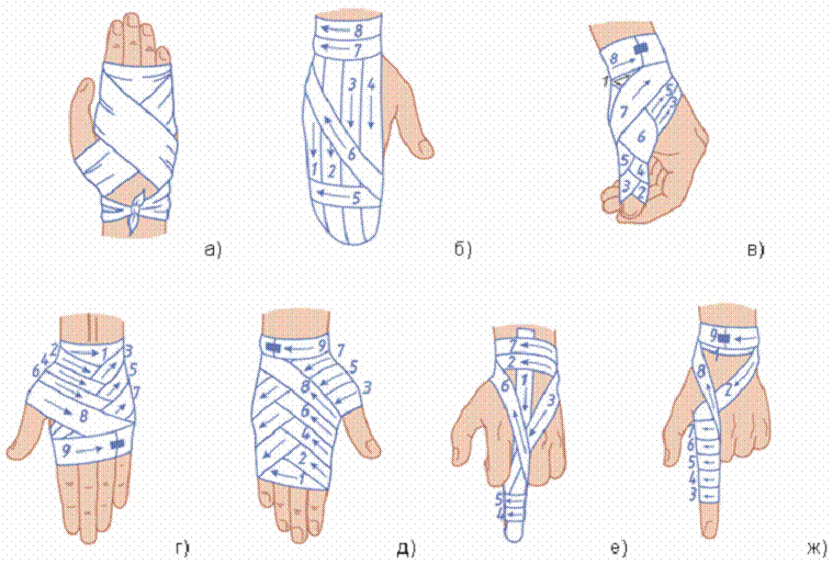 Схема бинтования руки при переломе. Схемы бинтовых повязок. Бинтование руки бинтом. Схема бинтования большого пальца.