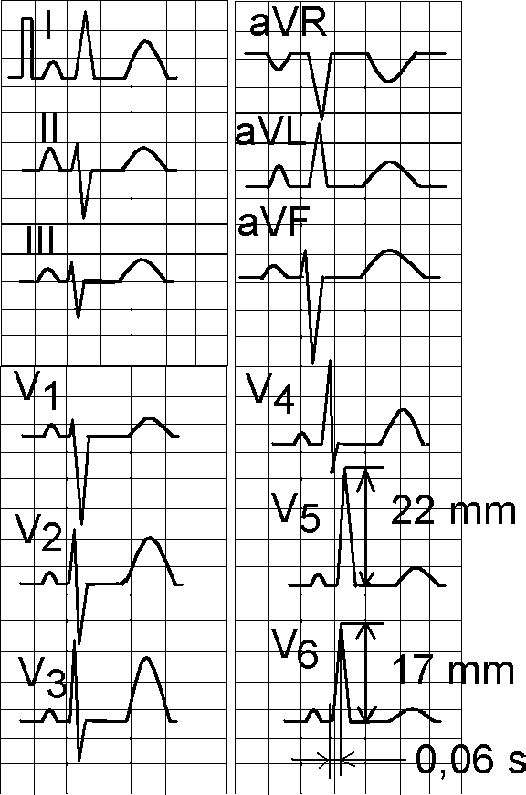 Экг отклонена влево. Расщепление QRS В 3 отведении. Расщепленный зубец r в AVF. Зубец r в v5. Раздвоенный зубец r на ЭКГ.