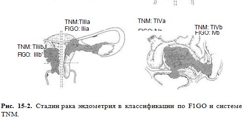 Рак эндометрия выживаемость