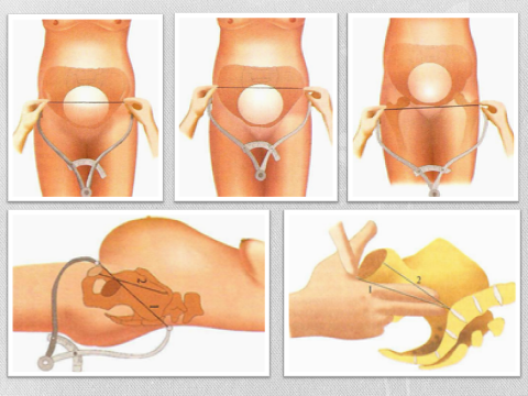 Пельвиометрия при беременности. Пельвиометрия. Измерение Distantia spinarum. Наружная пельвиометрия в акушерстве. Измерение наружных размеров таза пельвиометрия.
