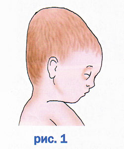 Почему голова вытянутая. Долихоцефалическая форма головы у плода. Форма черепа у грудничка Родничок. Долихоцефалическая форма головы новорожденного ребенка. Теменная кефалогематомы.