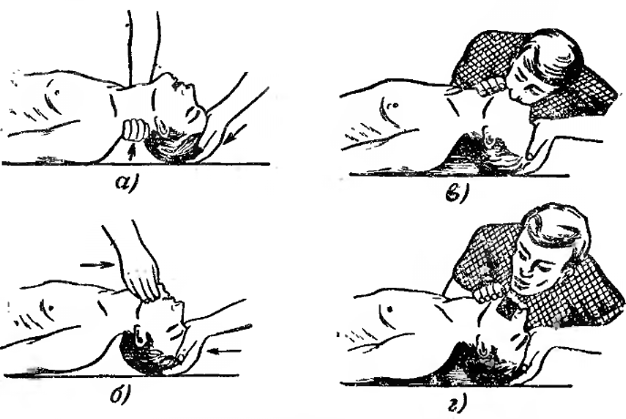 Искусственное дыхание методом рот ко рту осуществляется. Техника искусственного дыхания при утоплении. Схема проведения искусственного дыхания. Искусственное дыхание рот в рот при утоплении. Положение пострадавшего при проведении искусственного дыхания?.
