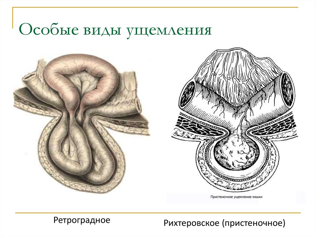 Какова клиническая картина при рихтеровском ущемлении