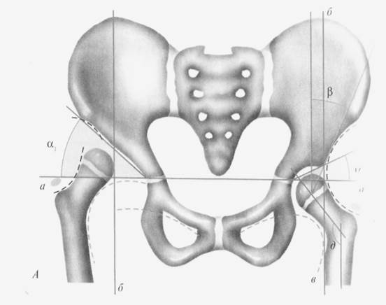 Врожденный вывих бедра. Угол Виберга тазобедренного сустава. Линия Кальве Шентона Перкина Хильгенрейнера. Линия Шентона Возраст. Врожденный вывих бедра линия Шемакера.