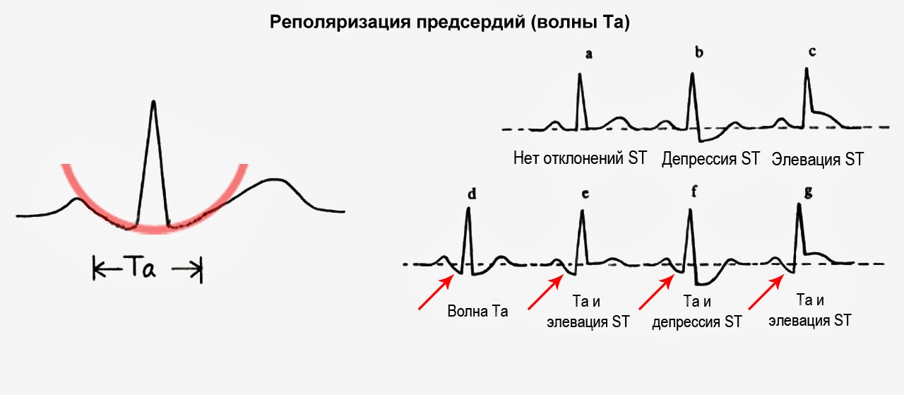 Нарушение реполяризации нижней. Реполяризация предсердий на ЭКГ. Реполяризация предсердий зубец. Реполяризация это в ЭКГ. ЭКГ деполяризация и реполяризация.