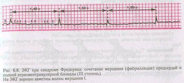 Полная ав блокада карта вызова скорой медицинской