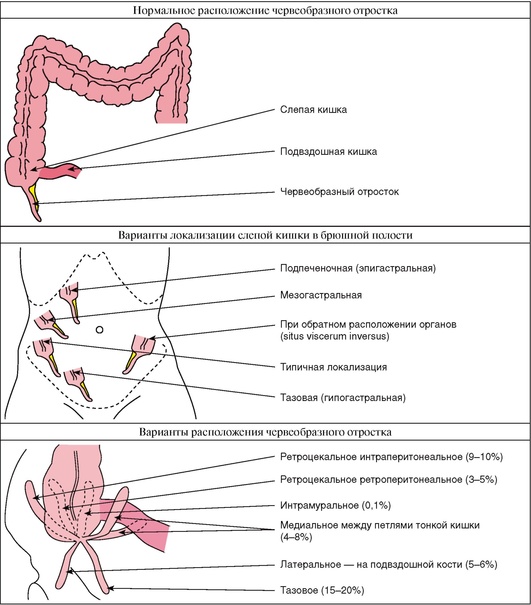 Аппендицит расположение схема