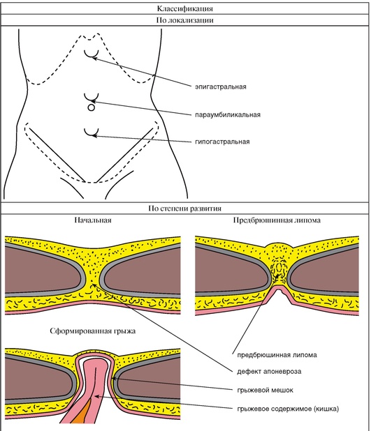 Грыжа белой линии живота на узи фото описание