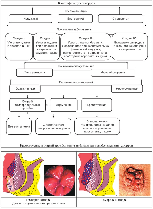 Лечение геморроя клинические. Острый геморрой классификация. Стадии геморроя схема наружный. Классификация острого геморроя стадии. Хронический геморрой классификация.
