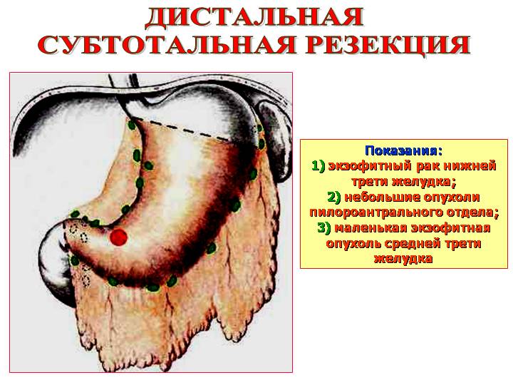 Нижняя треть желудка. Пилороантрального отдела желудка.