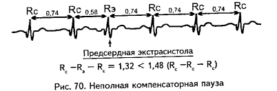 Компенсаторная пауза при экстрасистолии. Желудочковая экстрасистола компенсаторная пауза. Полная компенсаторная пауза при экстрасистолии на ЭКГ. Неполная компенсаторная пауза при экстрасистолии. Предсердные экстрасистолы на ЭКГ.