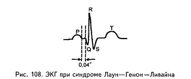 Клерка леви. Синдром LGL на ЭКГ. CLC синдром ЭКГ. Феномен LGL.