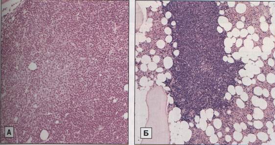 Пиоидный костный мозг. Хронический лимфоцитарный лейкоз микропрепарат. Хронический лимфолейкоз гистология. Хронический лимфолейкоз костный мозг. Хронический миелобластный лейкоз гистология.