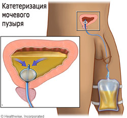 Уход за постоянным мочевым катетером фото