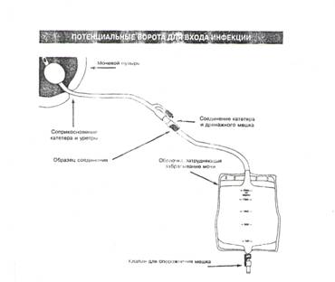 Уход за постоянным мочевым катетером фото
