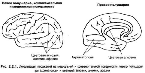 Локализация поражения. Зрительная агнозия очаг поражения. Агнозии схема поражения головного мозга. Слуховая агнозия локализация поражения.