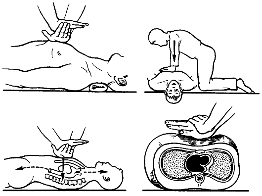 Непрямой массаж сердца рисунок