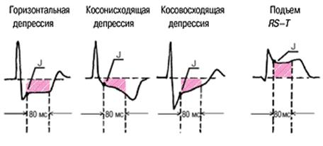 Депрессия сегмента st. Депрессия сегмента St на ЭКГ точка j. Точки j и i на ЭКГ. Косонисходящая депрессия сегмента St на ЭКГ. Точка i на ЭКГ.