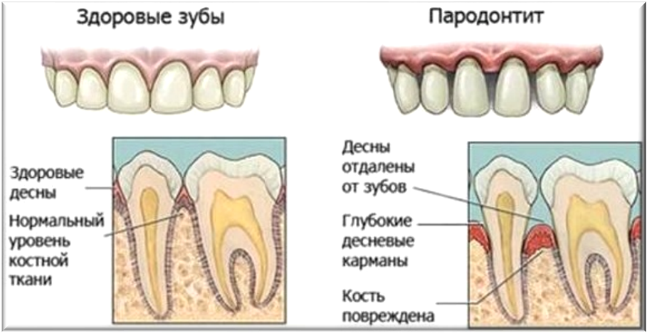 Состояние пародонта. Оценка состояния тканей пародонта. Деструктивные заболевания пародонта. Заболевания пародонта классификация клинические проявления. Пародонтальный карман строение.