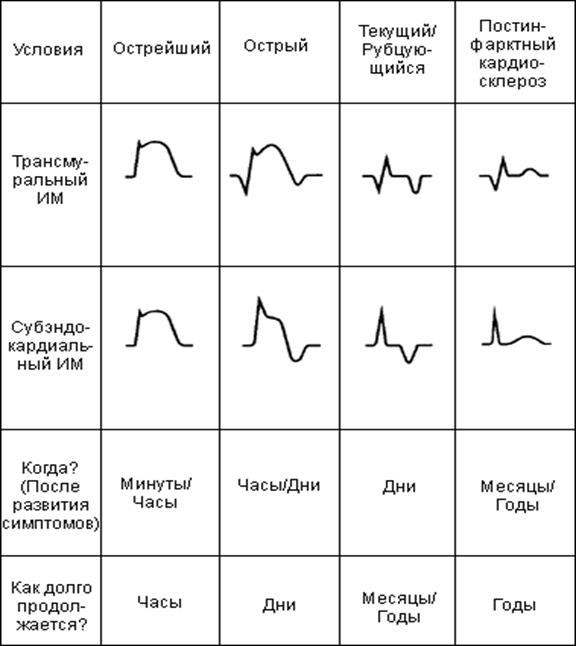 Стадии инфаркта на экг картинках