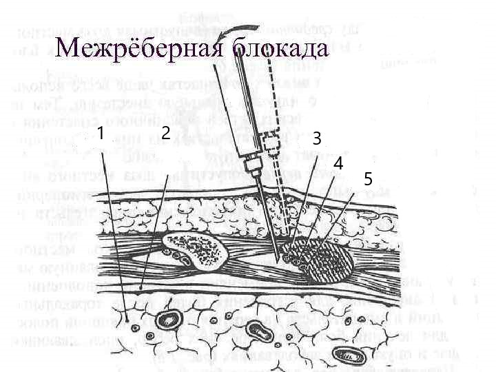 Блокады при переломах. Техника проведения межреберной новокаиновой блокады. Межреберная блокада техника выполнения. Новокаиновая блокада межреберных нервов. Межреберная новокаиновая блокада алгоритм.