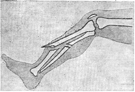Открытый перелом кости руки. Схема закрытого (слева) и открытого (справа) перелома костей голени.. Открытый перелом кости.