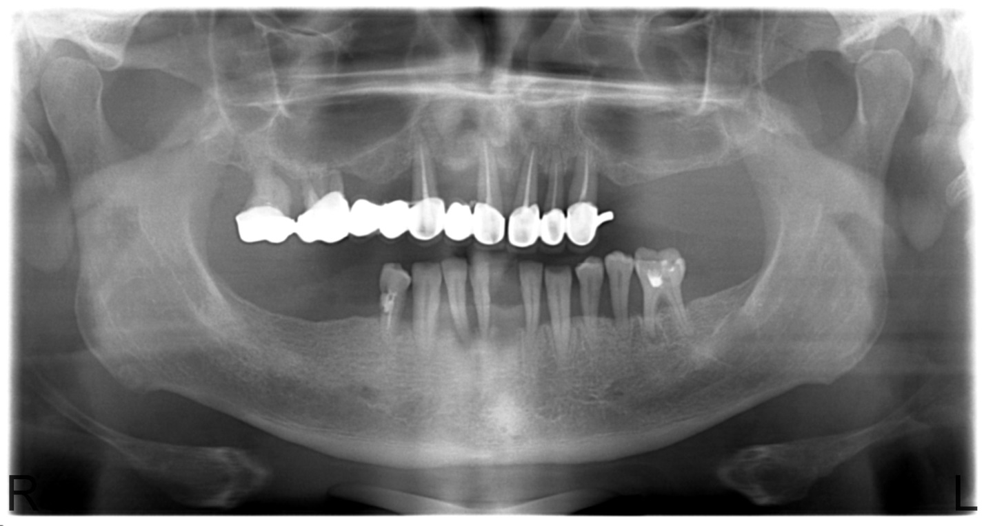 Рентгенологическая картина костной ткани челюстей при пародонтите тяжелой степени