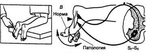 Схема дуги ахиллова рефлекса