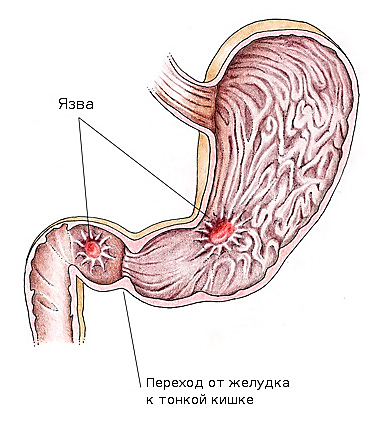 Язвенная болезнь желудка картинки